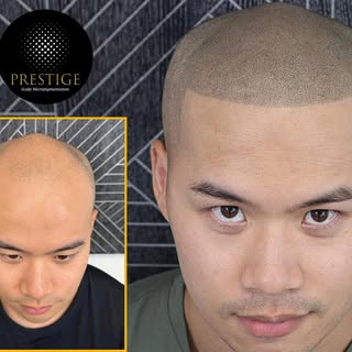 Hair Tattoo done right!

Prestige Scalp Micropigmentation offering the best of the best natural resu