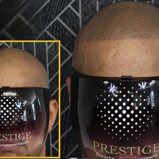 From bald to a defined hairline. 🔥

This client wanted the look of a fresh lineup without the daily