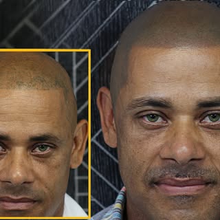 Two sessions. One complete transformation.

A previous SMP left this client with an unnatural, patch