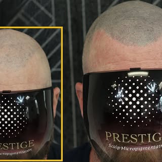 That “cheap” SMP ended up costing more in the long run. 💯 A botched scalp micropigmentation procedu
