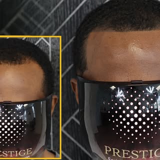 Hairline restored. Confidence renewed. 💯

A natural-looking hairline can completely transform your 