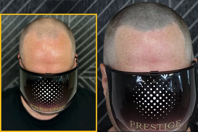 Second SMP session complete! 🔥 We added another layer of density, strengthened the hairline, and ca