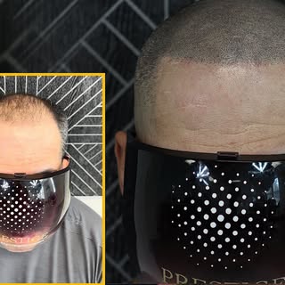Hair loss doesn’t have to control your confidence. 💯

This SMP transformation recreates the look of