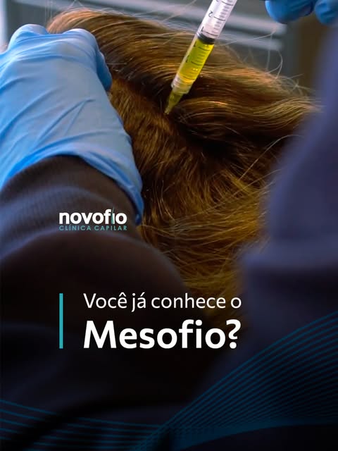 O Mesofio é um tratamento realizado diretamente no couro cabeludo, com a aplicação de ativos que atu