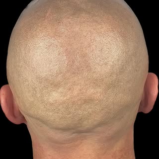 "Crowning Glory: Achieving a flawless crown fill with scalp micropigmentation! 👑✨ 

"Small Needles,