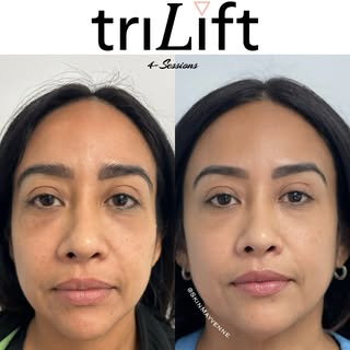 🤯 𝗪𝗢𝗪…𝟰 𝗦𝗘𝗦𝗦𝗜𝗢𝗡𝗦!
‌⁣
Client concerns: ⁣
⁣
❌Under Eyes⁣
❌Discoloration⁣
❌Smile lines ⁣
❌