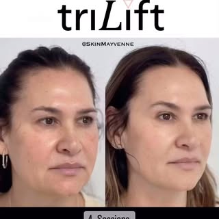 The best nonsurgical facelift solution🌟⁣ PERIOD!
⁣
Whether it’s recontouring cheeks, jawline, nasol