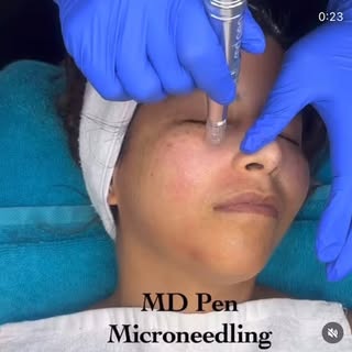 𝗠𝗗𝗣𝗲𝗻 𝗠𝗶𝗰𝗿𝗼 𝗡𝗲𝗲𝗱𝗹𝗶𝗻𝗴
‌
𝗪𝗵𝘆 𝗠𝗗𝗣𝗲𝗻?
✔️FDA Approved
✔️Perfect for all skin ty