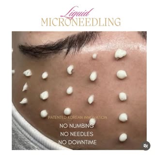 LIQUID MICRONEEDLING
‌
𝗪𝗵𝗮𝘁 𝗶𝘁 𝗱𝗼𝗲𝘀:
Clinically proven to minimize the appearance of wrink