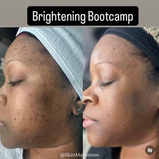 Brightening Bootcamp💪🏼

Patient suffered from post inflammatory hyperpigmentation and sun damage. 