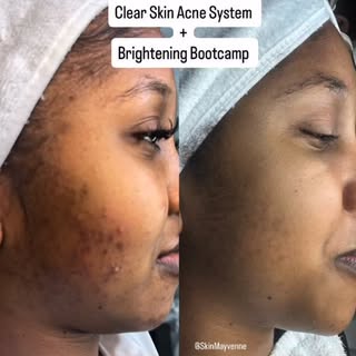 😮‍💨CLEAR SKIN ACNE SYSTEM + Brightening Bootcamp!
‌⁣
2 Systems…now flawless #nomakeupneeded skin.
