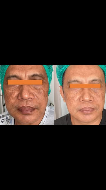 Memperbaiki kulit flek melasma : TIDAK MUDAH
TDK INSTAN 

TAPI BISA.

Foto : sample case  yg dikerja