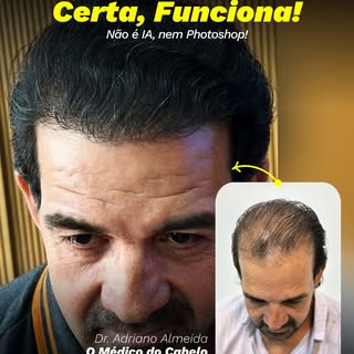 A técnica faz toda a diferença. 
Quando o transplante capilar é realizado com planejamento, experiên