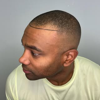 🔬 Experience the latest in hair restoration techniques available right near Greensboro! 

🌱 Our ex