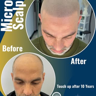 10 Years Later… This Is Why SMP Touch-Ups Matter.

Most people think once you get scalp micropigment
