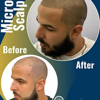 Here’s a local success story for you: Adrian, right here from Greensboro, had a hair transplant year