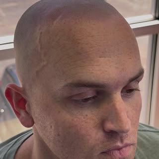10 years ago, a random Uber ride changed everything.
One passenger mentioned Scalp Micropigmentation
