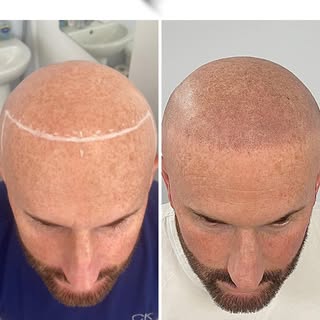 Our results 🤩

Contact us to start your hair transformation journey 📲Link in bio. 

#smp #scalpmic