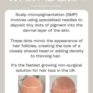SMP is the fastest growing non-surgical solution for hair loss in the UK. 

Contact us today for a f