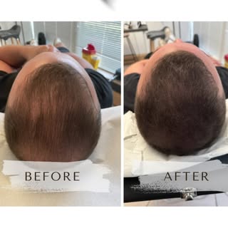 Another successful density enhancement! 🤩

Confidence restored. Results you can see.

At SMP Clinic