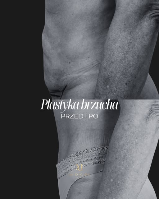 Plastyka brzucha- 2,5 miesiąca po zabiegu.

Co dzieje się z brzuchem na tym etapie rekonwalescencji?