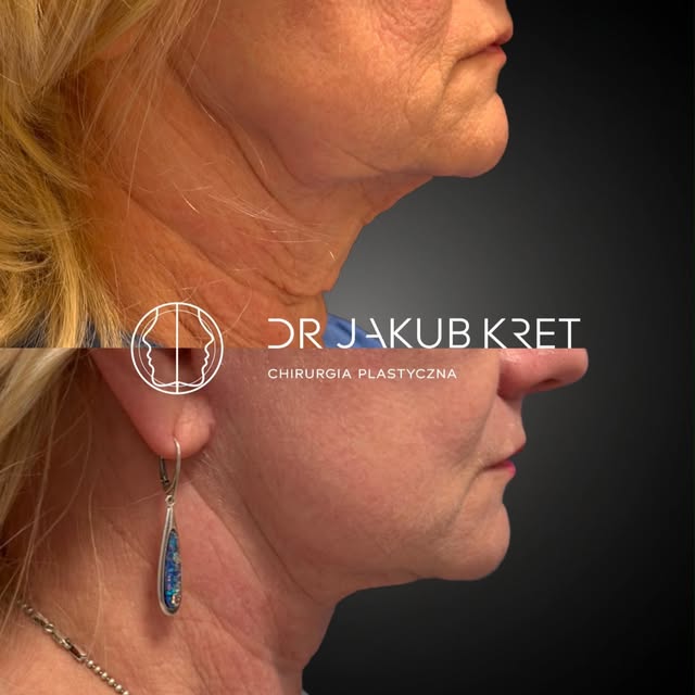 Pacjentka 6 miesięcy po zabiegu Deep Plane Face&Necklift. W tej operacji nie chodzi o „naciągnięcie”