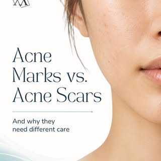 Still calling every spot left after acne a “scar”? 🤨

A flat mark and a change in skin texture are 