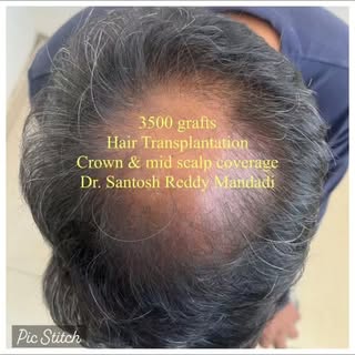 Hair loss doesn't have to define you. Confidence can grow back. 🌱

This patient underwent 3500 graf
