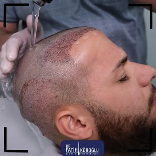 "Elevate your hair transplant journey with soothing, therapeutic hair washing."
#hairtransplant #drf