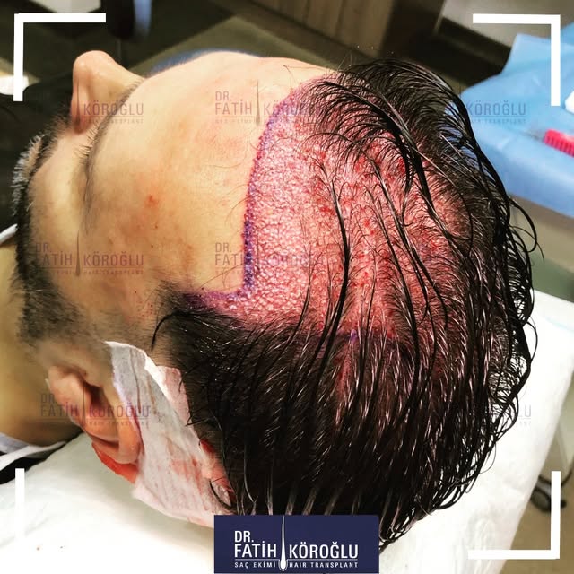 You can be the next person to get this popular treatment option at Dr. Fatih Köroğlu Hair Clinic
#ha