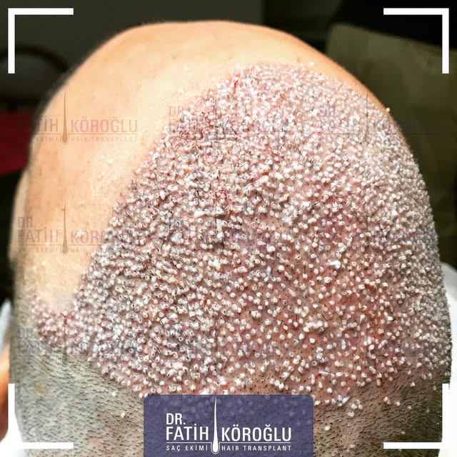 Hair transplant surgery will change your life. It will transform your confidence and make you look y