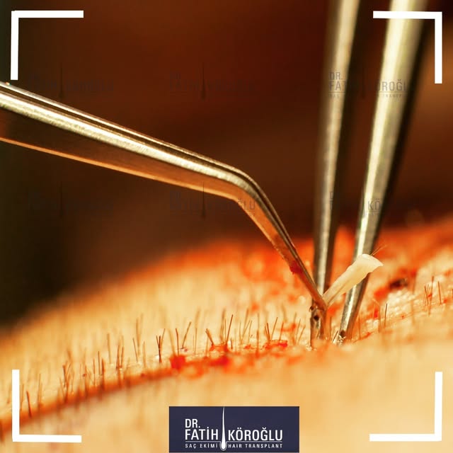 Hair transplant process requires each and every detail to be paid attention to. Dr. Fatih Köroğlu al