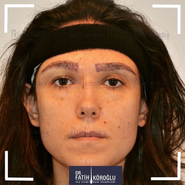 Enhance your brows with a natural and fuller look through an eyebrow transplant.
#EyebrowTransplant 