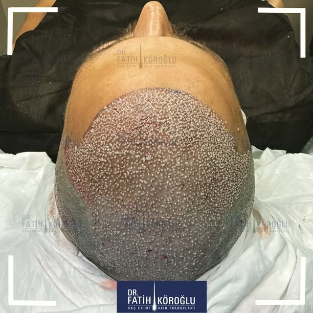 You can expect to get the highest possible quality of a hair transplant at well-known hair restorati