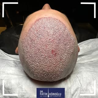 "With modern techniques, hair transplant recovery is quicker than ever."
#hairtransplant #drfatihkor