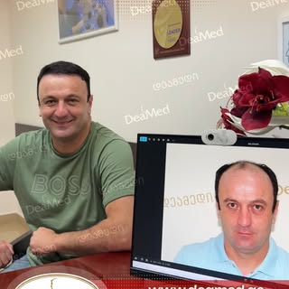 #hairtransformation #hairtransplant #თმისგადანერგვა #deamed