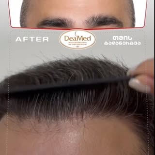 👩‍⚕️ Natural hairline restoration by Dr. Diana Papaskiri.
✅ The Result