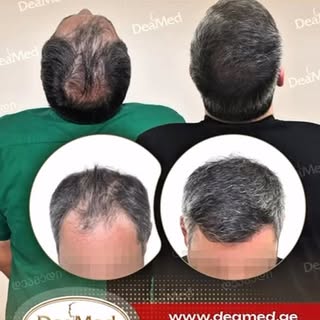 #4850Grafts
#თმისგადანერგვა #თმისტრანსპლანტაცია #თმისცვენა #თმისაღდგენა თმისჯანმრთელობა თმისტრანსპლა