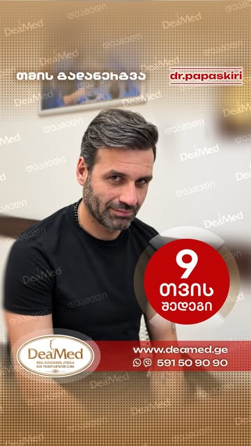#hairtransplant #hairtransformation #deamed #თმისგადანერგვა