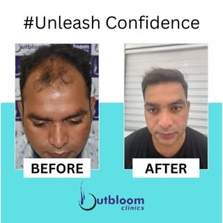 Outbloom Clinics is the best place for hair transplant in India using advanced FUE technique. Dr Akl