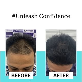 Outbloom Clinics is the best place for hair transplant in India using advanced FUE technique. Dr Akl