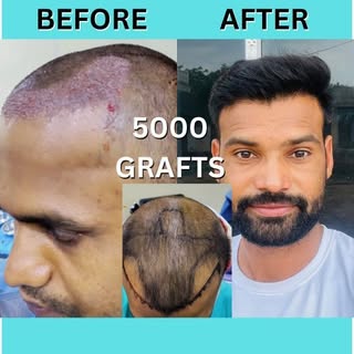 Outbloom Clinics is the best place for hair transplant in India using advanced FUE technique. Dr Akl