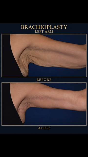 40 kg lost. The next chapter: addressing the loose skin left behind.

After significant weight loss,