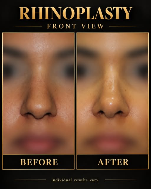 A small change in the nose can make a meaningful difference to facial balance.

In this front-view r