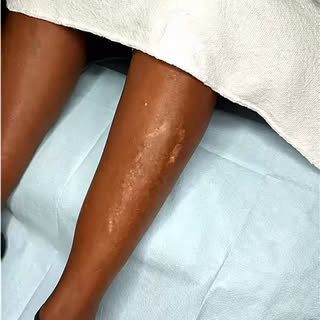 ✨ Scar Camouflage Transformation

Today’s client came in feeling self-conscious about scars on her s