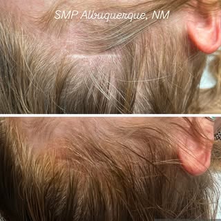 ✨ Scalp Micropigmentation for Scar Restoration ✨

Today’s session focused on carefully blending scal