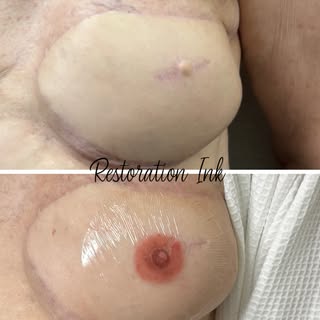 This client came in wanting to restore symmetry and a natural appearance after surgery. Using advanc
