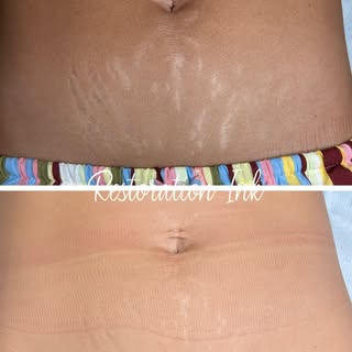 Real results. Real confidence.

Stretch marks tell a story, but they don’t have to be the first thin