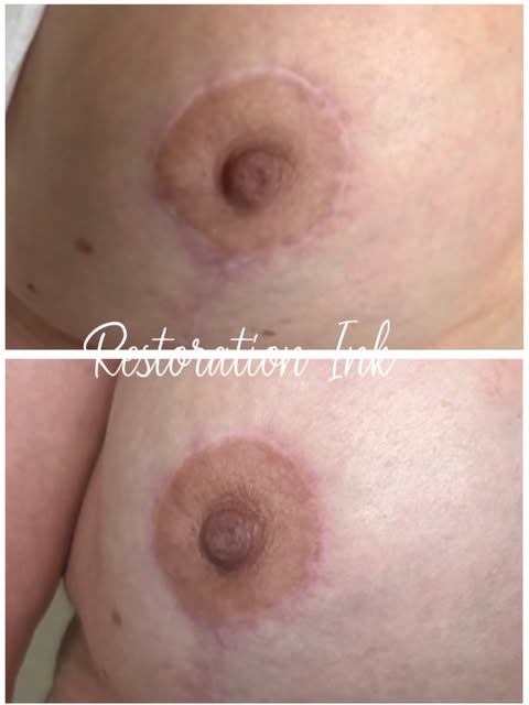 Areola Scar Camouflage - 6 Weeks Healed! ✨

Scar tissue can leave behind lighter areas that stand ou