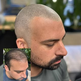 🔥 From Hair Transplant Struggles to Confidence Boost! 🔥

🔹 Tried a hair transplant but didn’t get